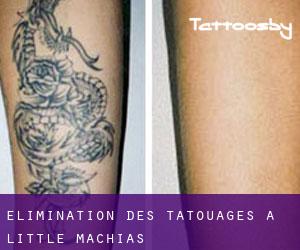 Élimination des tatouages à Little Machias