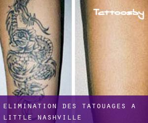 Élimination des tatouages à Little Nashville