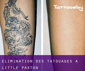 Élimination des tatouages à Little Paxton