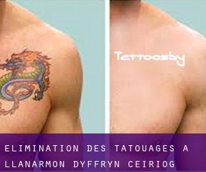 Élimination des tatouages à Llanarmon Dyffryn-Ceiriog