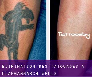 Élimination des tatouages à Llangammarch Wells