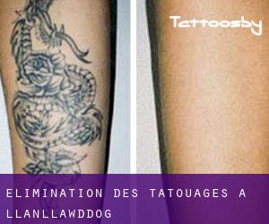 Élimination des tatouages à Llanllawddog
