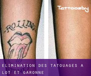 Élimination des tatouages à Lot-et-Garonne