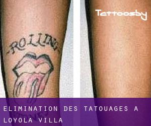 Élimination des tatouages à Loyola Villa