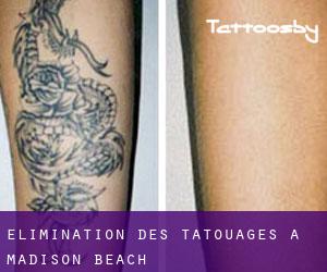 Élimination des tatouages à Madison Beach