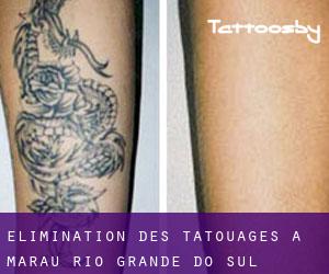 Élimination des tatouages à Marau (Rio Grande do Sul)