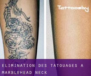Élimination des tatouages à Marblehead Neck