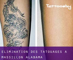 Élimination des tatouages à Massillon (Alabama)