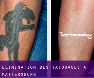 Élimination des tatouages à Mattersburg