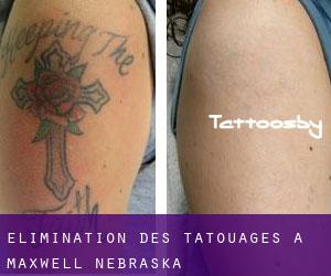 Élimination des tatouages à Maxwell (Nebraska)