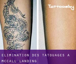 Élimination des tatouages à McCall Landing