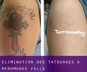Élimination des tatouages à Menomonee Falls