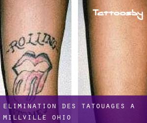Élimination des tatouages à Millville (Ohio)