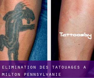 Élimination des tatouages à Milton (Pennsylvanie)