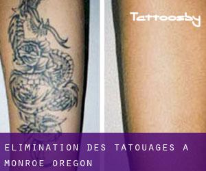 Élimination des tatouages à Monroe (Oregon)