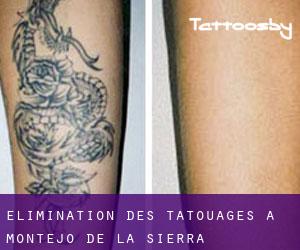 Élimination des tatouages à Montejo de la Sierra