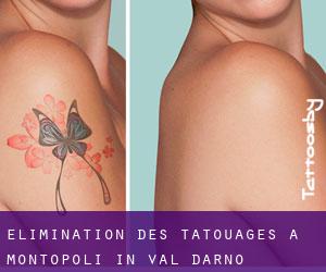 Élimination des tatouages à Montopoli in Val d'Arno