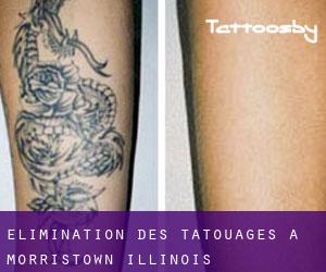 Élimination des tatouages à Morristown (Illinois)