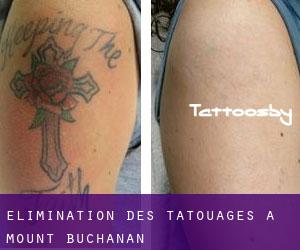 Élimination des tatouages à Mount Buchanan