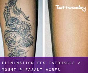 Élimination des tatouages à Mount Pleasant Acres