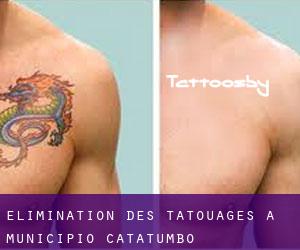 Élimination des tatouages à Municipio Catatumbo