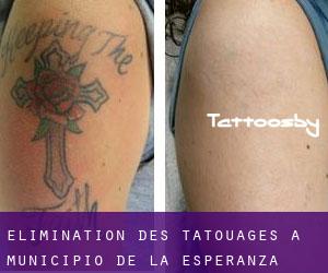 Élimination des tatouages à Municipio de La Esperanza