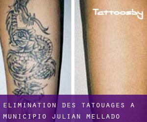 Élimination des tatouages à Municipio Julián Mellado