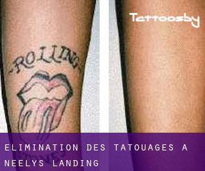 Élimination des tatouages à Neelys Landing