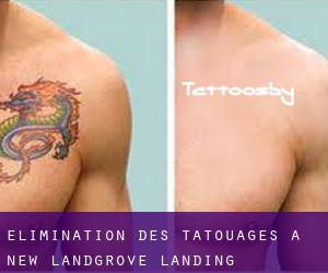 Élimination des tatouages à New Landgrove Landing