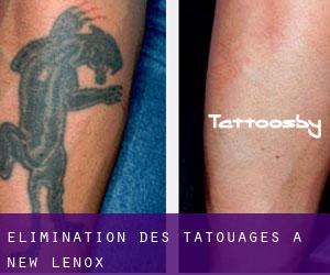 Élimination des tatouages à New Lenox