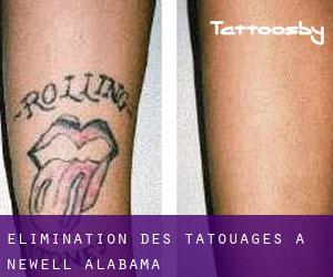 Élimination des tatouages à Newell (Alabama)