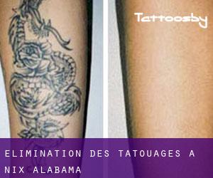 Élimination des tatouages à Nix (Alabama)