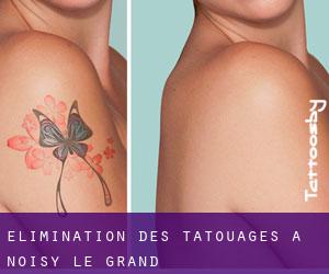 Élimination des tatouages à Noisy-le-Grand