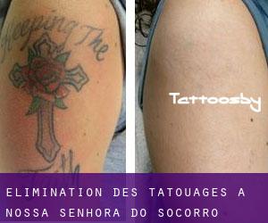 Élimination des tatouages à Nossa Senhora do Socorro