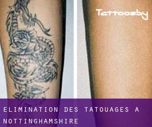 Élimination des tatouages à Nottinghamshire