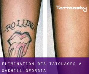 Élimination des tatouages à Oakhill (Georgia)