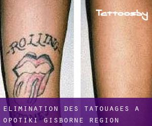Élimination des tatouages à Opotiki (Gisborne Region)