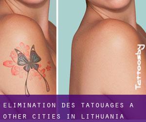 Élimination des tatouages à Other Cities in Lithuania