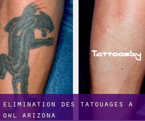 Élimination des tatouages à Owl (Arizona)