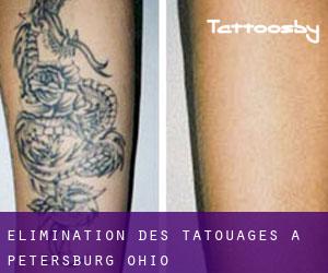 Élimination des tatouages à Petersburg (Ohio)