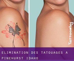 Élimination des tatouages à Pinehurst (Idaho)