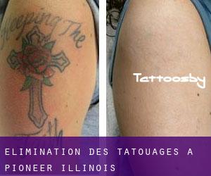 Élimination des tatouages à Pioneer (Illinois)