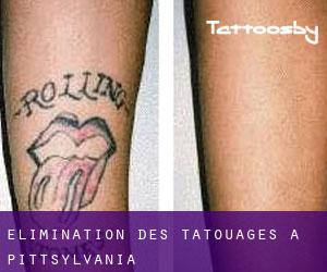 Élimination des tatouages à Pittsylvania