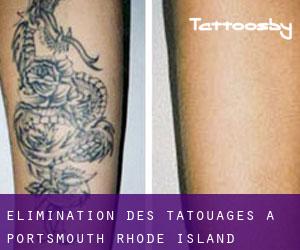 Élimination des tatouages à Portsmouth (Rhode Island)