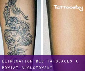 Élimination des tatouages à Powiat augustowski