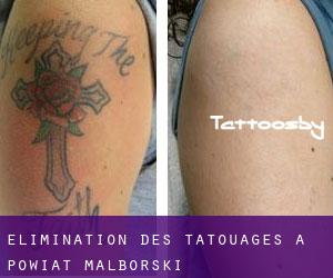 Élimination des tatouages à Powiat malborski