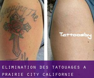 Élimination des tatouages à Prairie City (Californie)