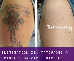 Élimination des tatouages à Princess Margaret Gardens
