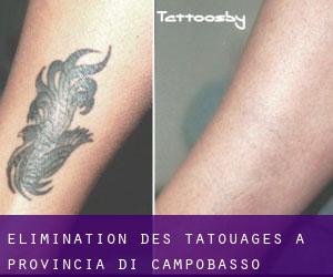 Élimination des tatouages à Provincia di Campobasso