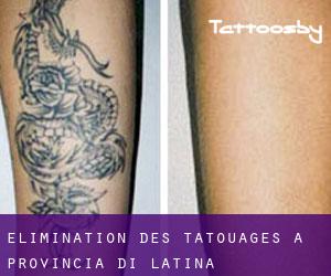 Élimination des tatouages à Provincia di Latina